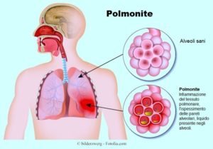 polmonite atipica